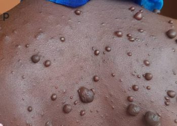Dossier: Taxer les victimes de maladies rares de sorciers, une abomination