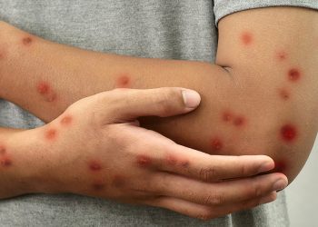 Santé : Un cas de Mpox détecté et confirmé chez une femme dans le district sanitaire du Golfe