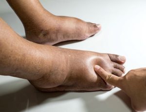 Examen clinique de pieds enfles Photo internet