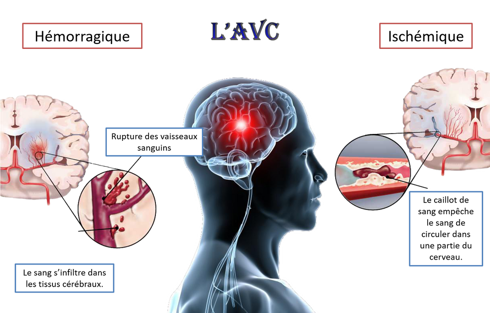 Mecanisme de survenue de lAVC Photo internet